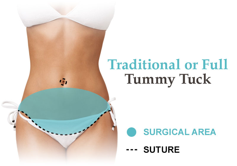 Tummy Tuck – Smart Shape Body