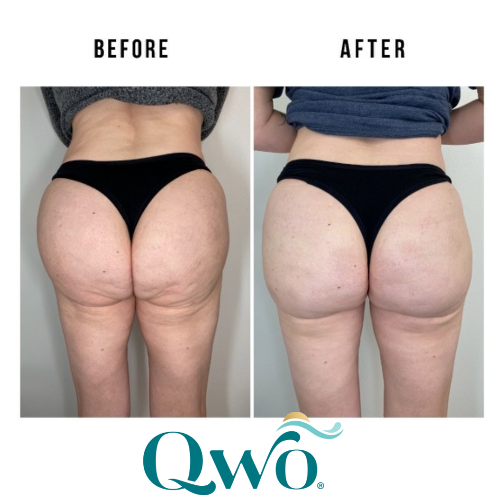 Qwo Cellulite Reduction - Bend Plastic Surgery