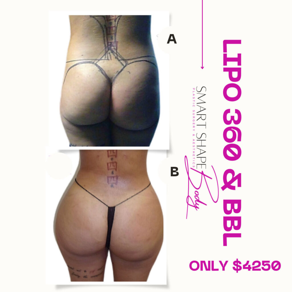 Lipo 360 + Body-tite swipe to see more of these amazing results