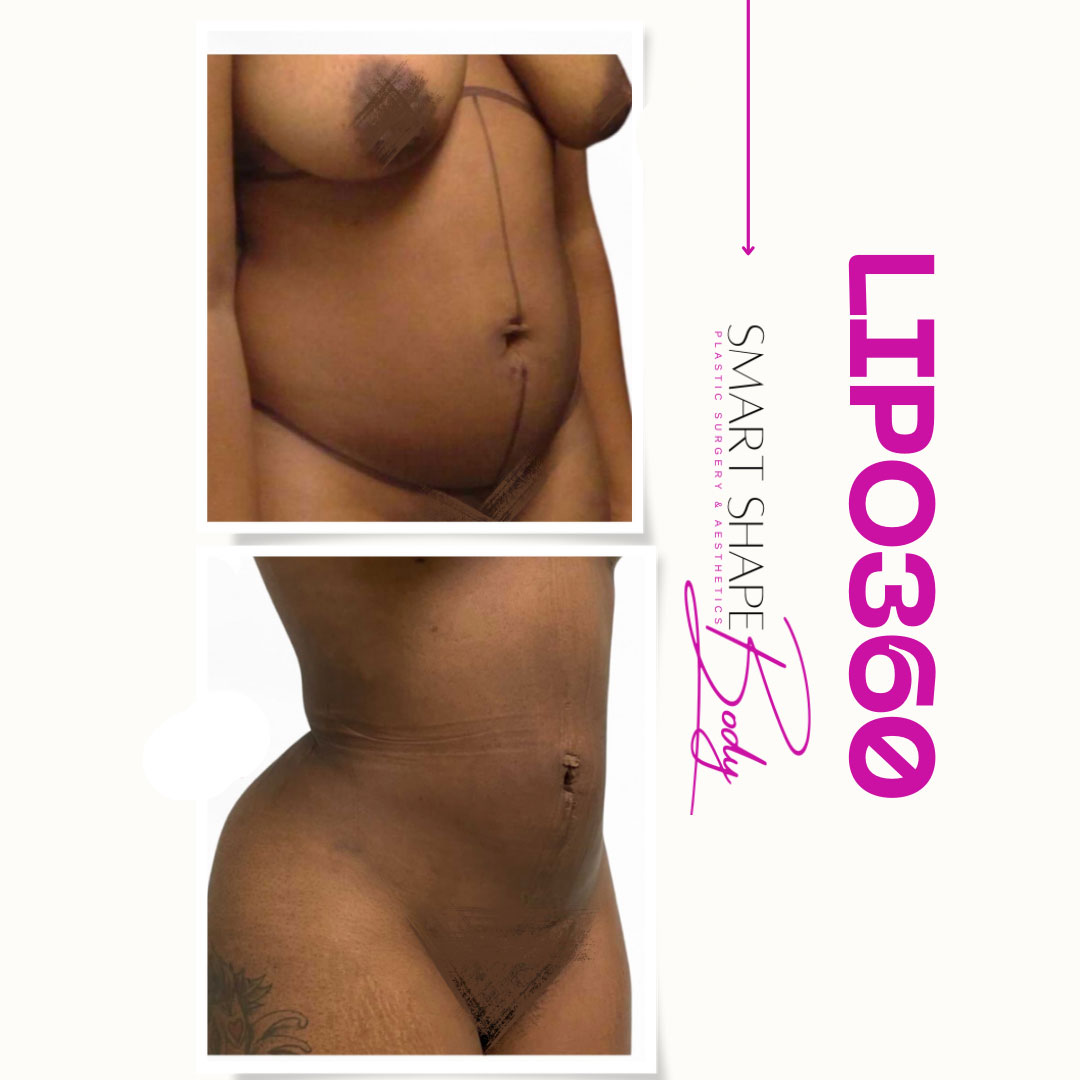 Before & After Lipo360 & BBL. This great patient sent us her